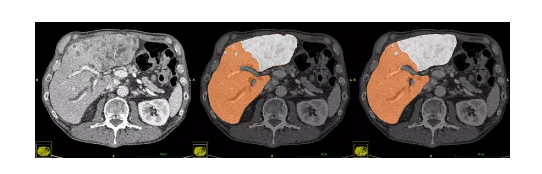 肝脏及结节分割技术的影像分析